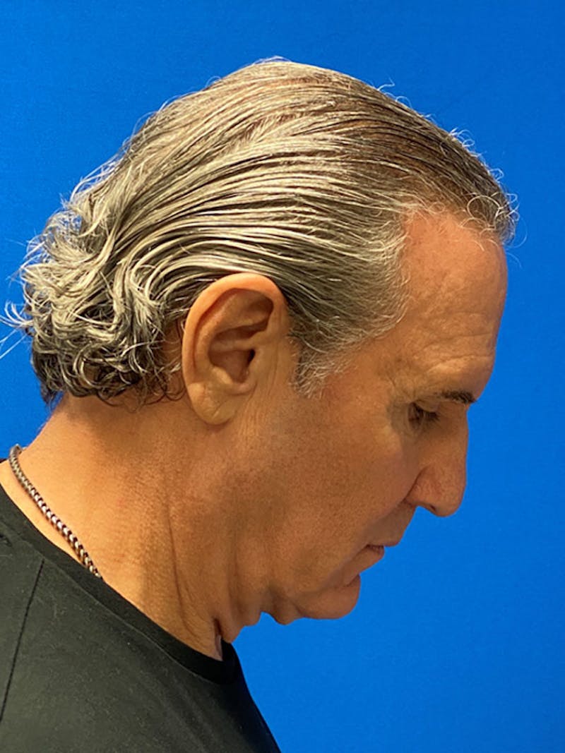 Facelift Before & After Gallery - Patient 359956 - Image 7