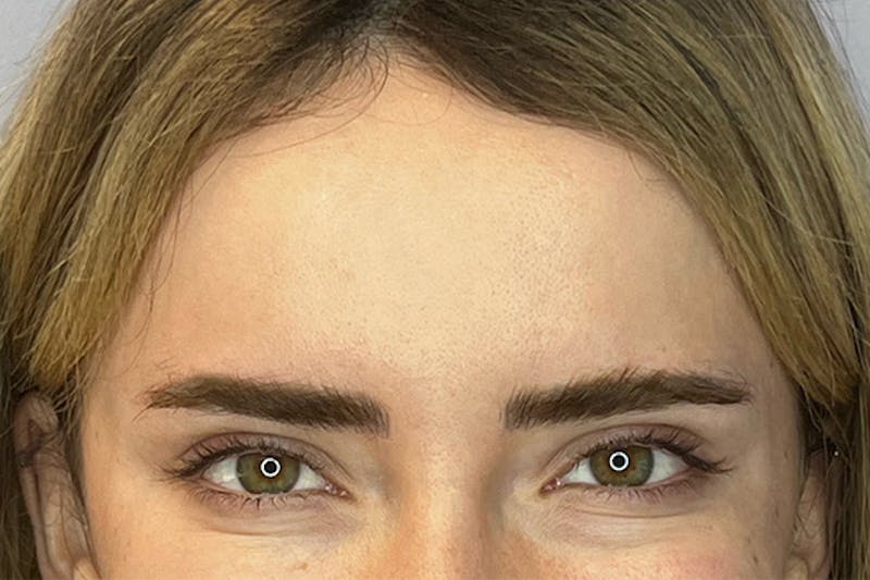 BOTOX Before & After Gallery - Patient 236004 - Image 6