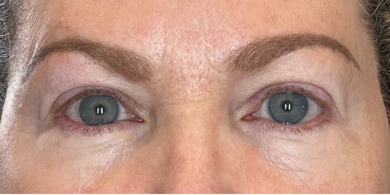 Dysport Before & After Gallery - Patient 139921 - Image 2