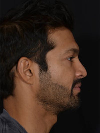 Primary Rhinoplasty Before & After Gallery - Patient 115999 - Image 1