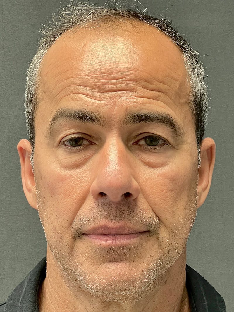 Male Face & Neck Before & After Gallery - Patient 180603 - Image 1