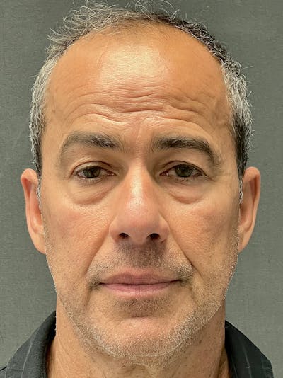 Male Face & Neck Before & After Gallery - Patient 180603 - Image 1