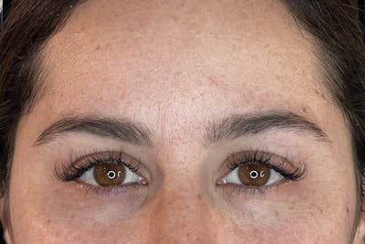 BOTOX Before & After Gallery - Patient 105783 - Image 1