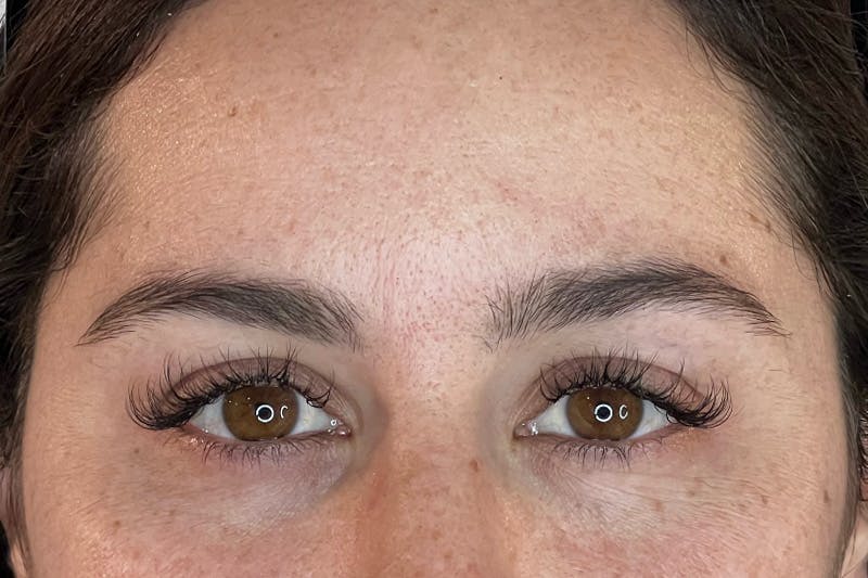 BOTOX Before & After Gallery - Patient 105783 - Image 1
