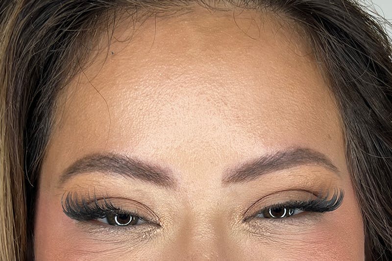 BOTOX Before & After Gallery - Patient 491781 - Image 6