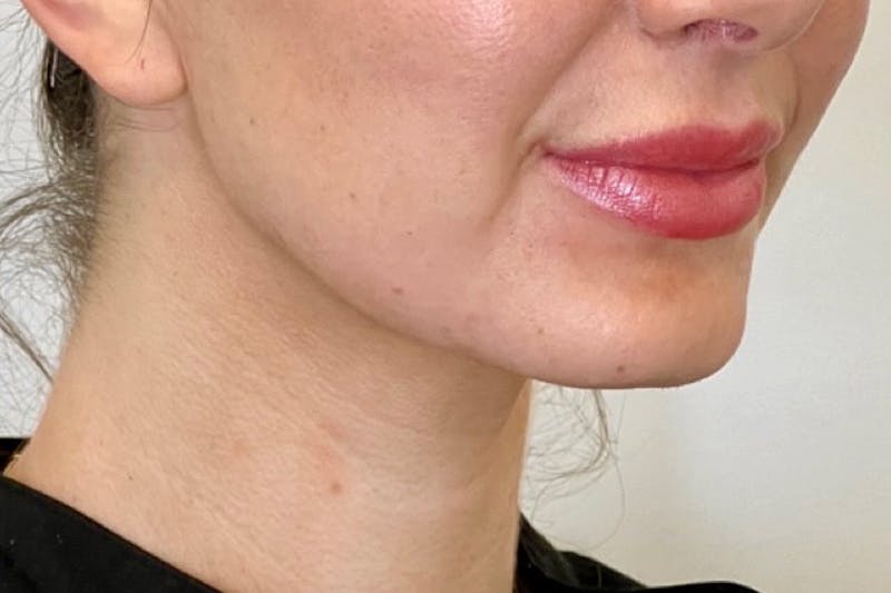 BOTOX Before & After Gallery - Patient 344936 - Image 4