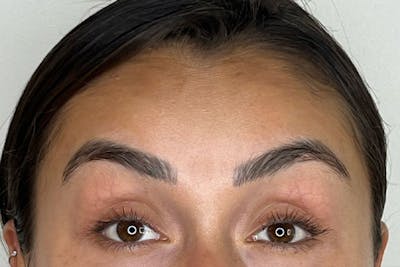 BOTOX Before & After Gallery - Patient 344438 - Image 2