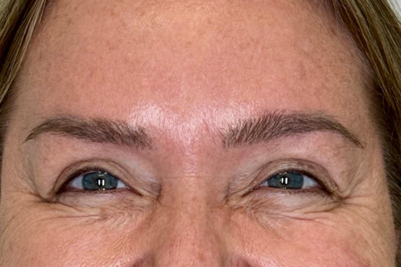 BOTOX Before & After Gallery - Patient 165391 - Image 4