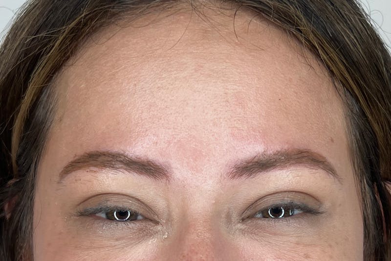BOTOX Before & After Gallery - Patient 491781 - Image 5