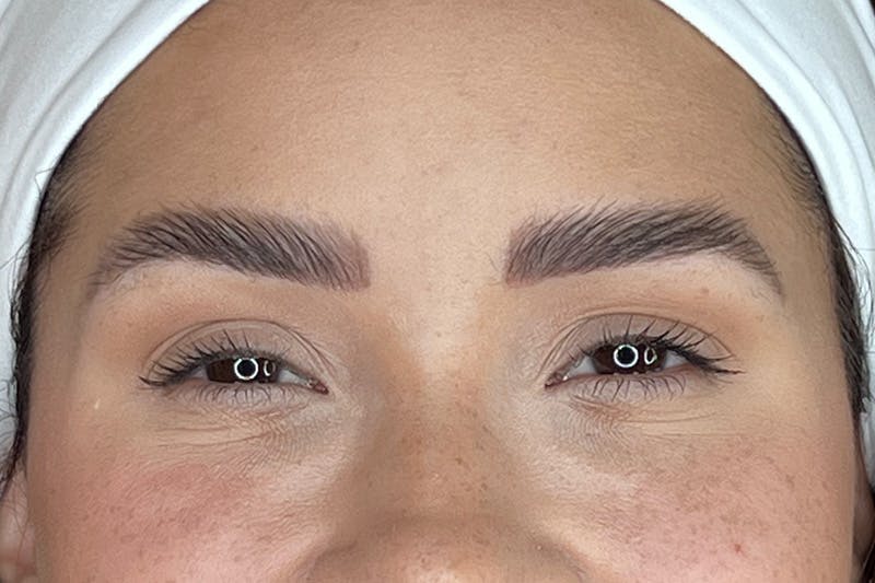 Dysport Before & After Gallery - Patient 116764 - Image 8