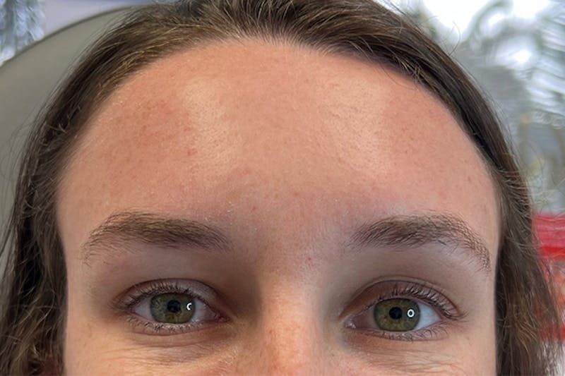 Dysport Before & After Gallery - Patient 182212 - Image 4