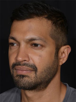 Male Face & Neck Before & After Gallery - Patient 452117 - Image 8