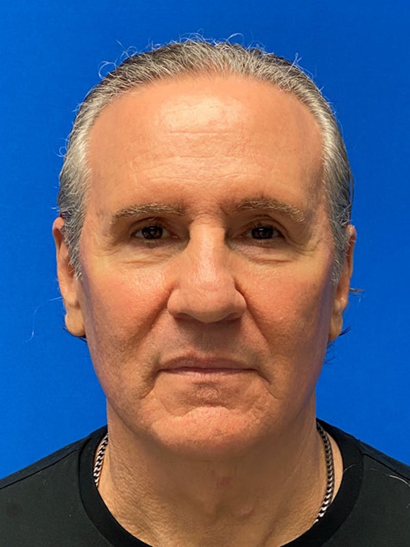 Facelift Before & After Gallery - Patient 359956 - Image 1