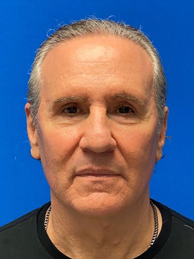 Male Face & Neck Before & After Gallery - Patient 333373 - Image 1