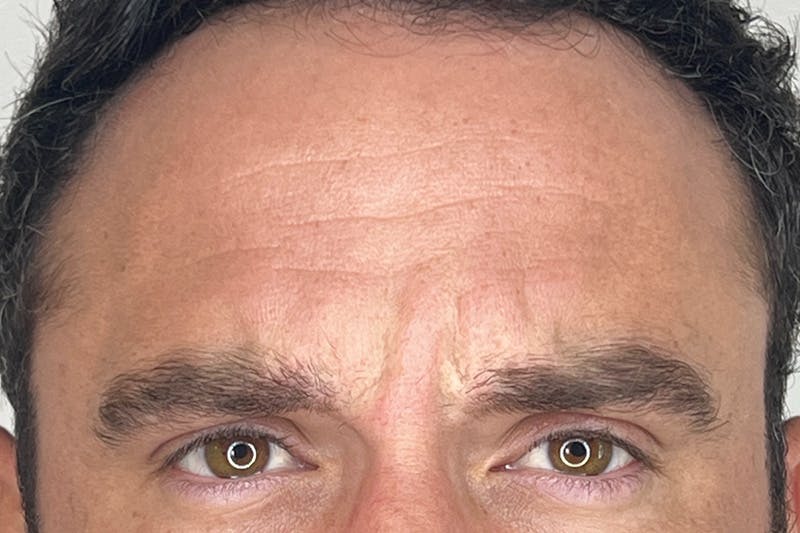 BOTOX Before & After Gallery - Patient 295976 - Image 3