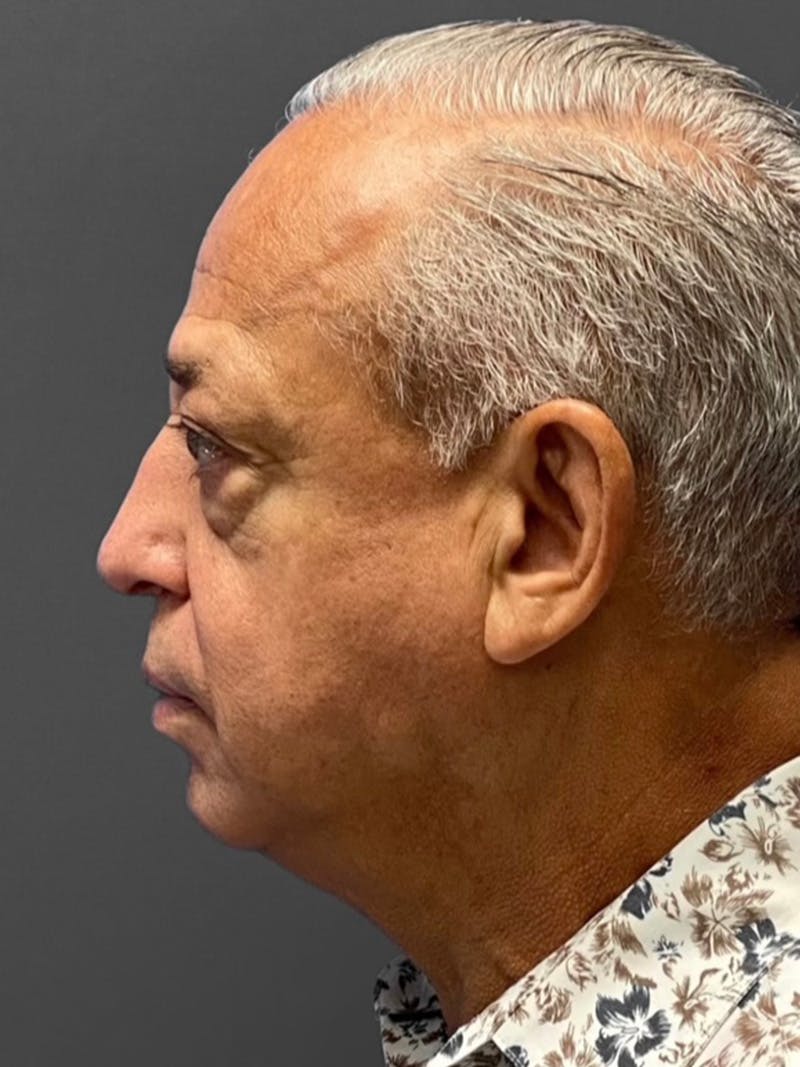 Facelift Before & After Gallery - Patient 420019 - Image 5