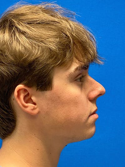 Primary Rhinoplasty Before & After Gallery - Patient 475057 - Image 1