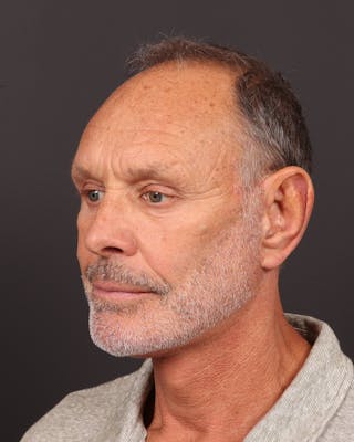 Facelift Before & After Gallery - Patient 501762 - Image 2