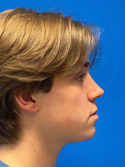 Primary Rhinoplasty Before & After Gallery - Patient 475057 - Image 2