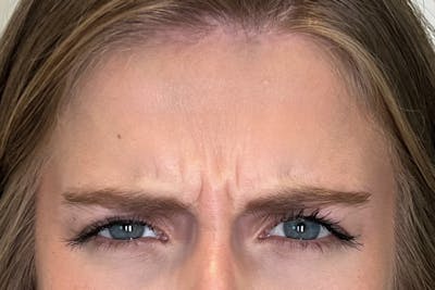 BOTOX Before & After Gallery - Patient 913658 - Image 1
