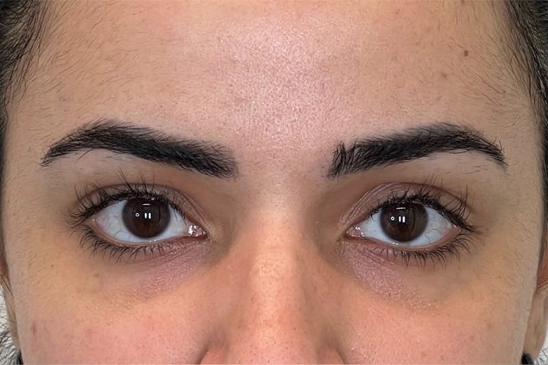 Dysport Before & After Gallery - Patient 168374 - Image 5