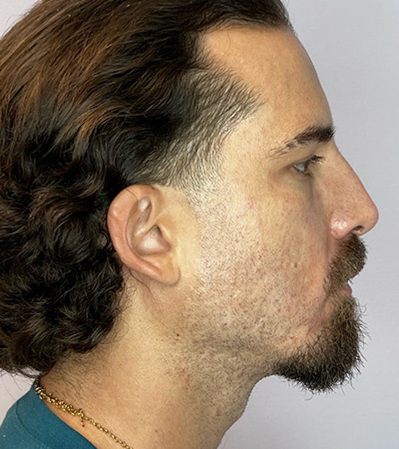 PRF Before & After Gallery - Patient 352072 - Image 1