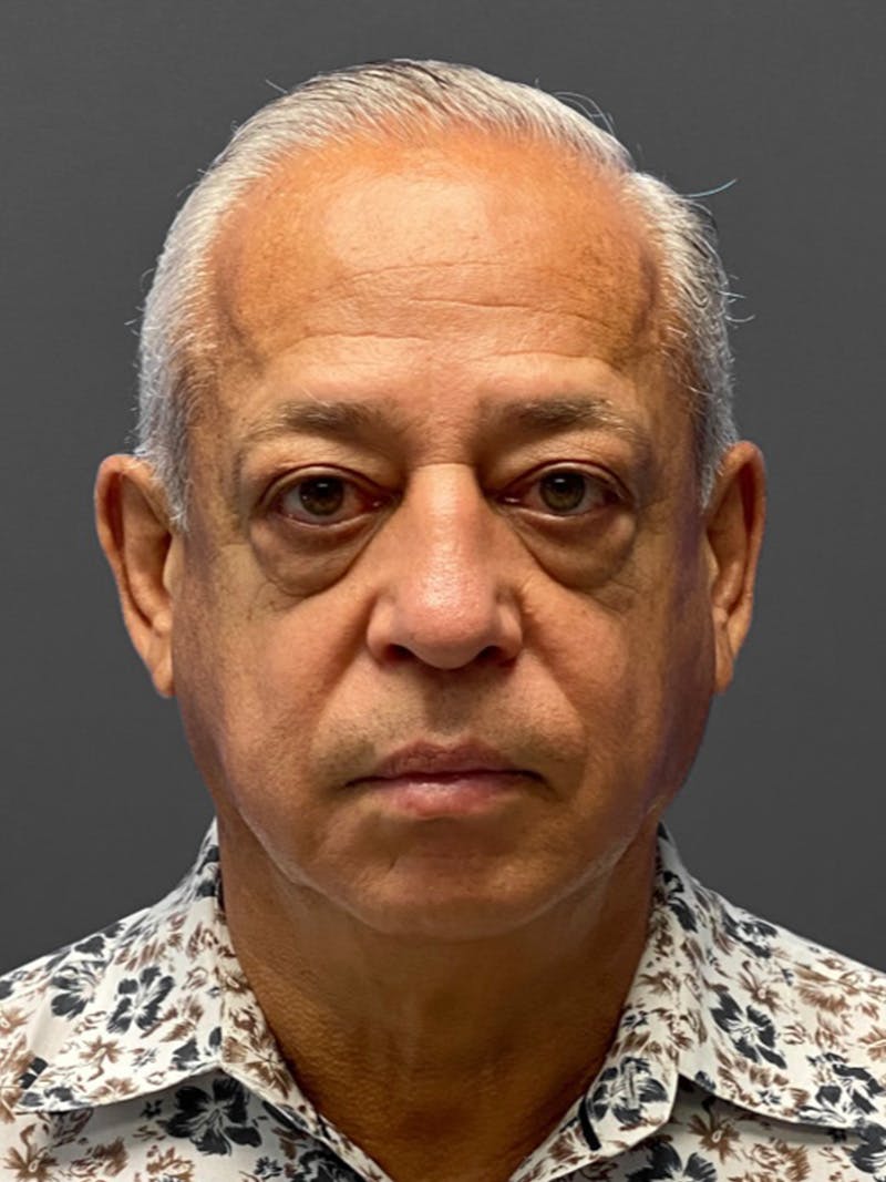 Facelift Before & After Gallery - Patient 420019 - Image 1