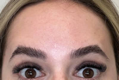 BOTOX Before & After Gallery - Patient 629113 - Image 2