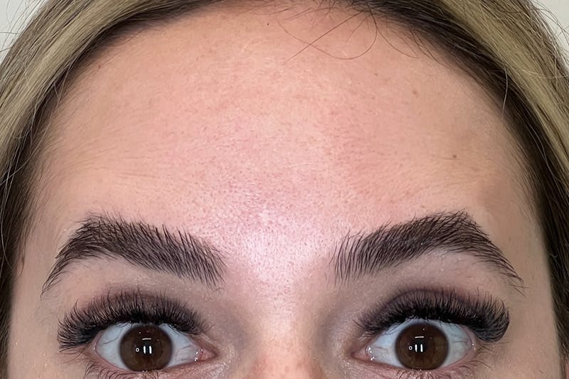 BOTOX Before & After Gallery - Patient 629113 - Image 2