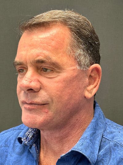 Male Face & Neck Before & After Gallery - Patient 202317 - Image 2