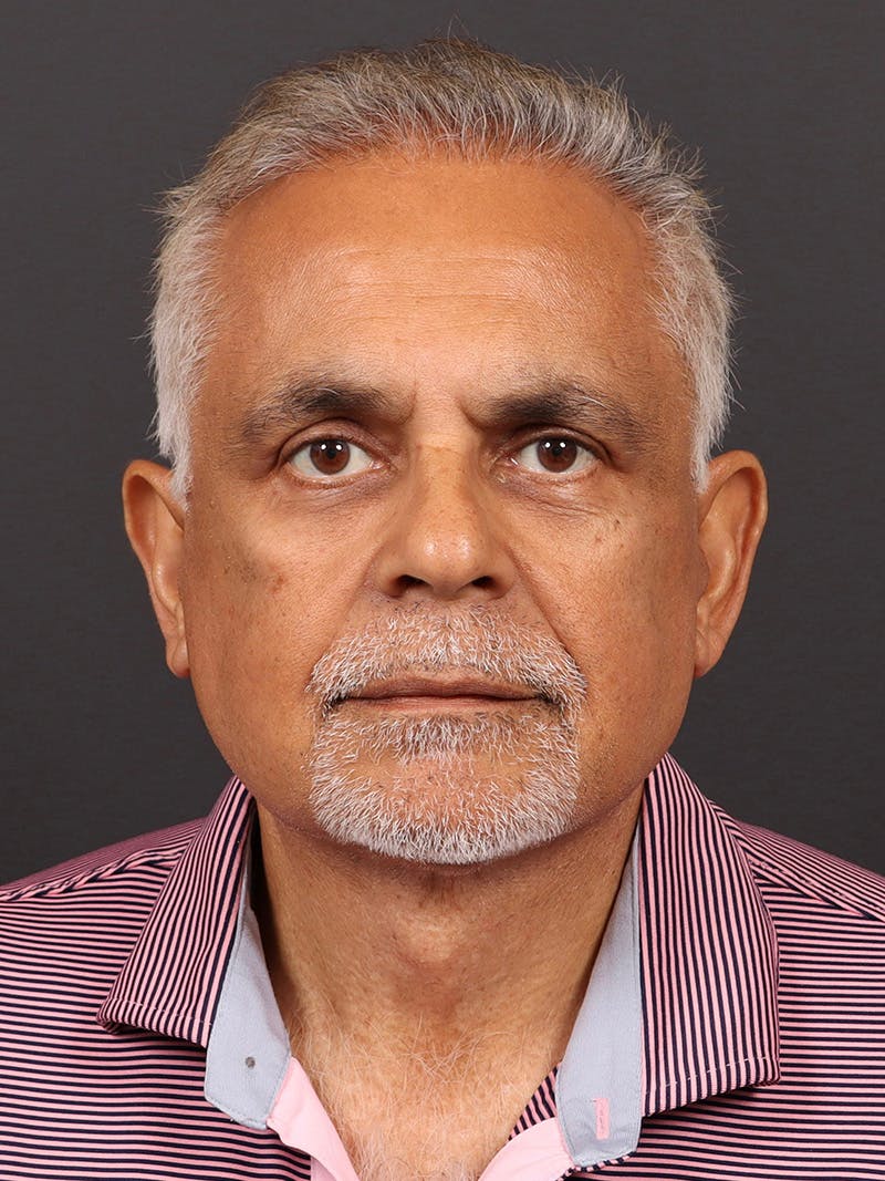 Male Face & Neck Before & After Gallery - Patient 114462 - Image 2