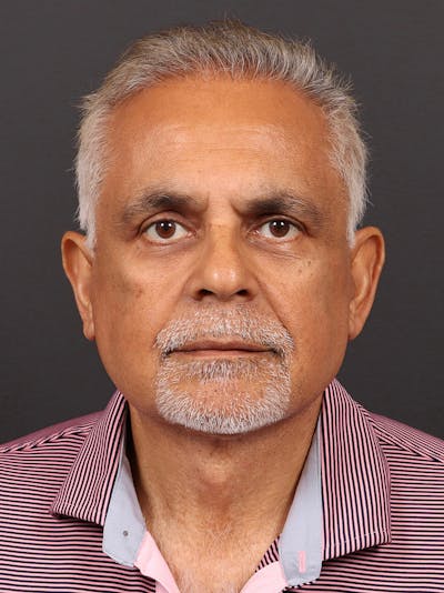 Male Face & Neck Before & After Gallery - Patient 114462 - Image 2