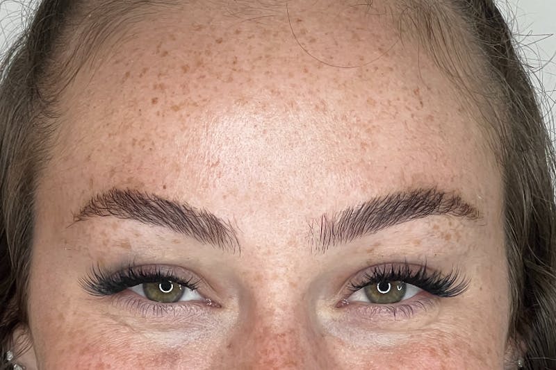 BOTOX Before & After Gallery - Patient 227379 - Image 4
