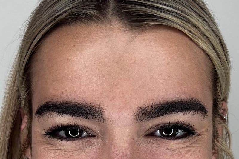 BOTOX Before & After Gallery - Patient 356623 - Image 3