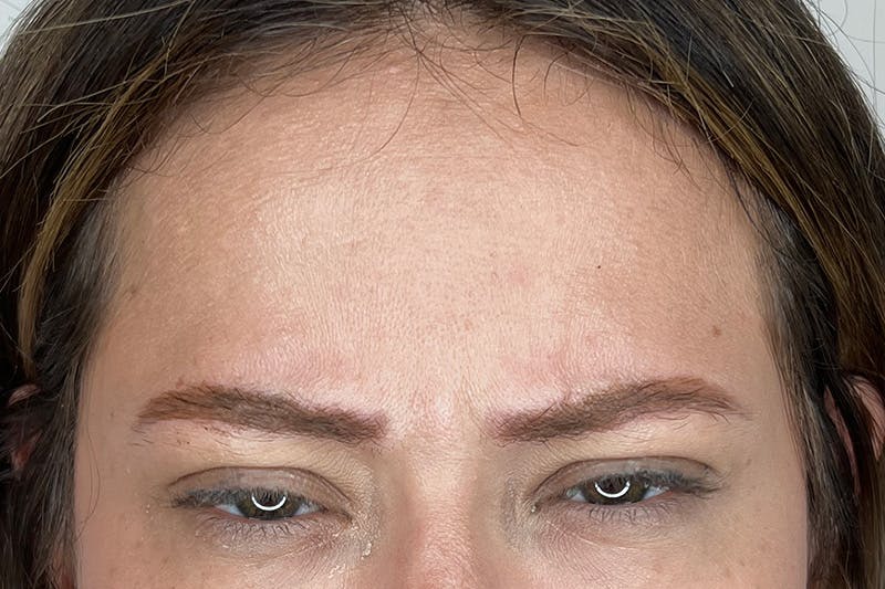 BOTOX Before & After Gallery - Patient 491781 - Image 3