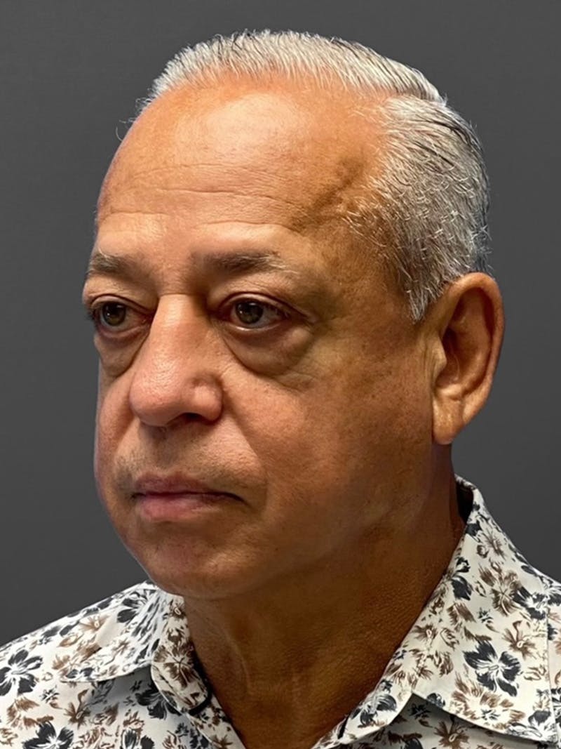 Facelift Before & After Gallery - Patient 420019 - Image 3