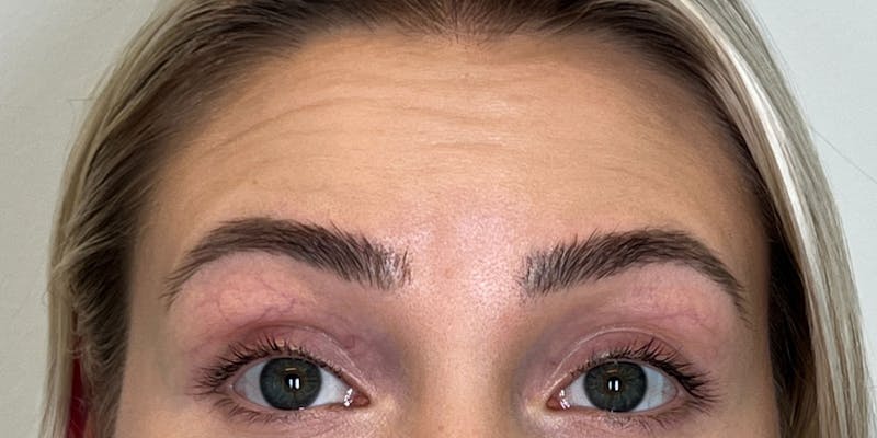 BOTOX Before & After Gallery - Patient 228341 - Image 1
