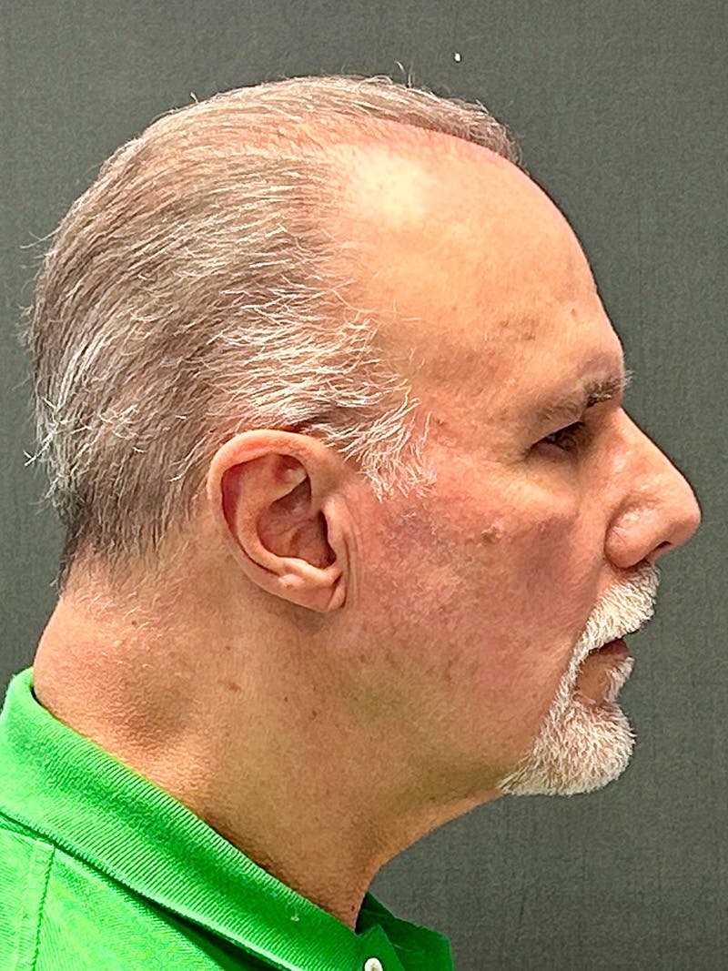Facelift Before & After Gallery - Patient 557057 - Image 5