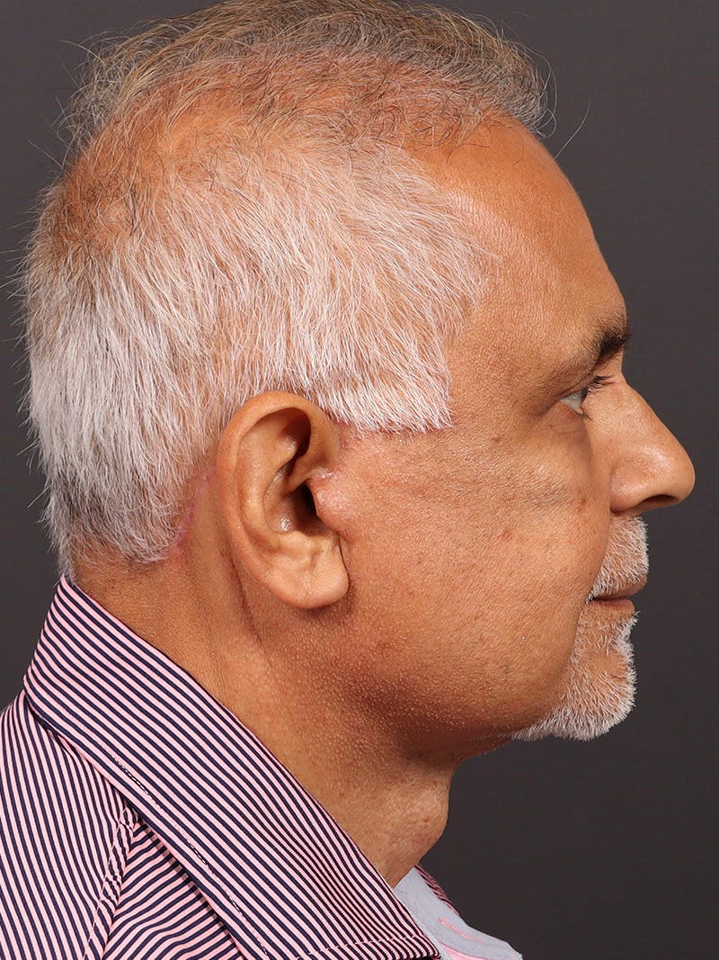 Male Face & Neck Before & After Gallery - Patient 114462 - Image 6