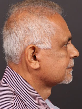 Male Face & Neck Before & After Gallery - Patient 114462 - Image 6