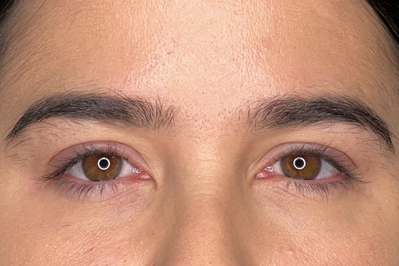 Dysport Before & After Gallery - Patient 310845 - Image 6
