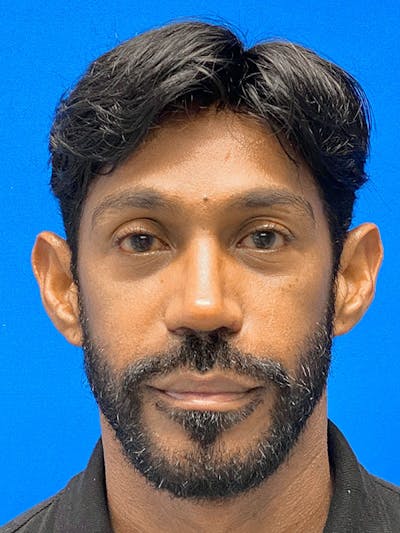 Male Face & Neck Before & After Gallery - Patient 377491 - Image 2