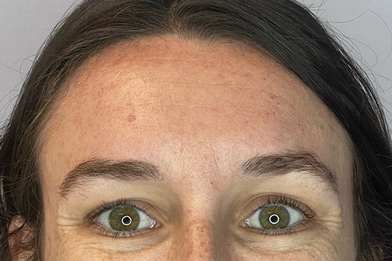 Dysport Before & After Gallery - Patient 182212 - Image 3