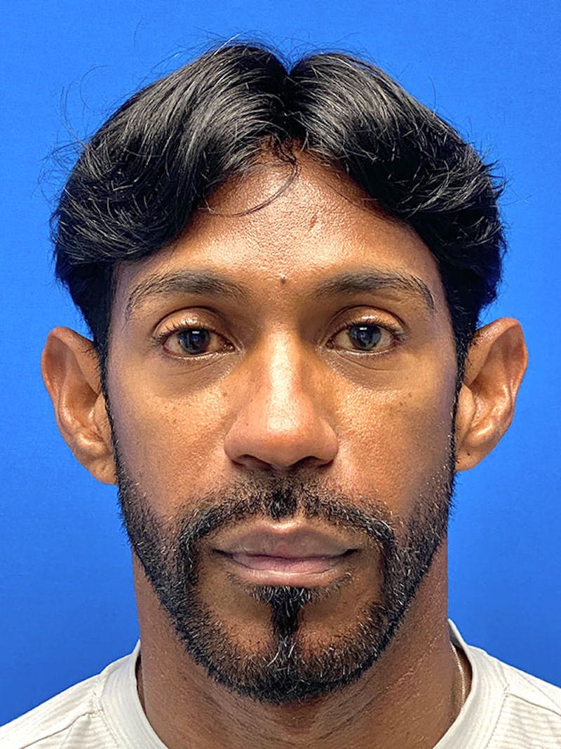 Primary Rhinoplasty Before & After Gallery - Patient 899073 - Image 3