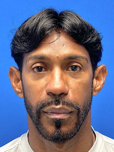 Male Face & Neck Before & After Gallery - Patient 377491 - Image 1