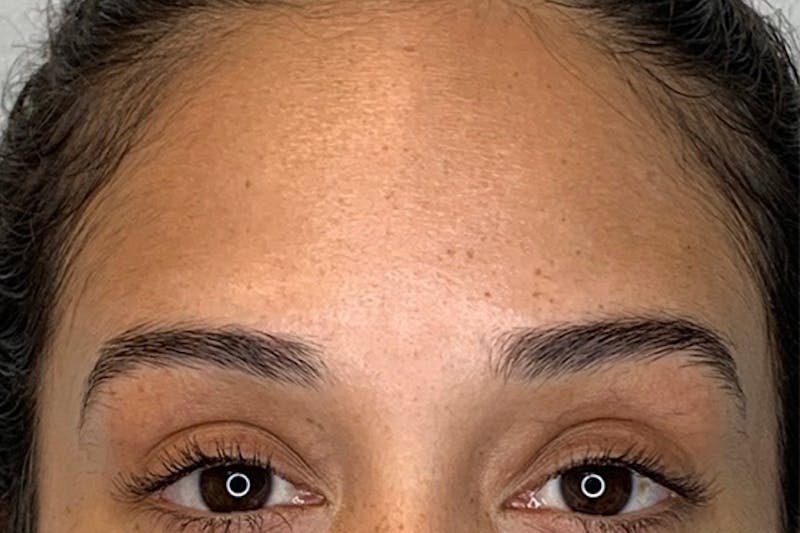 BOTOX Before & After Gallery - Patient 144247 - Image 2