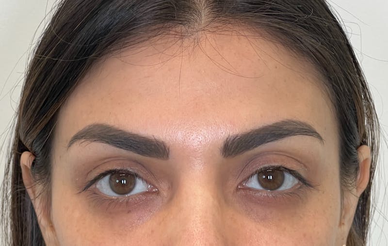 Dysport Before & After Gallery - Patient 309774 - Image 6