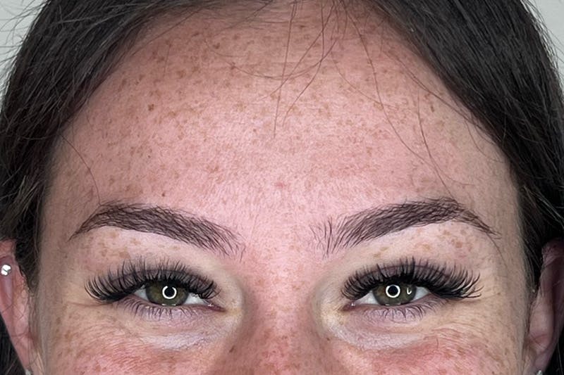 BOTOX Before & After Gallery - Patient 227379 - Image 3