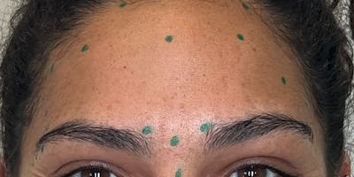 Dysport Before & After Gallery - Patient 120224 - Image 1