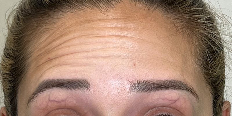 Dysport Before & After Gallery - Patient 258329 - Image 1